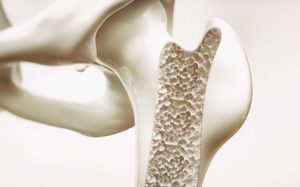 Symptômes de l’ostéoporose